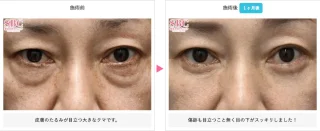 切開ハムラ法