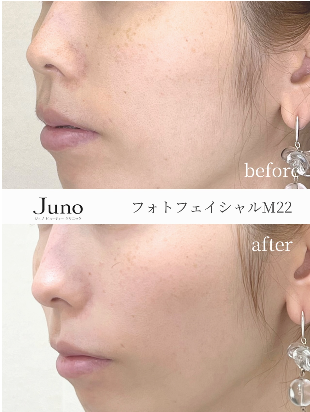フォトフェイシャルM22