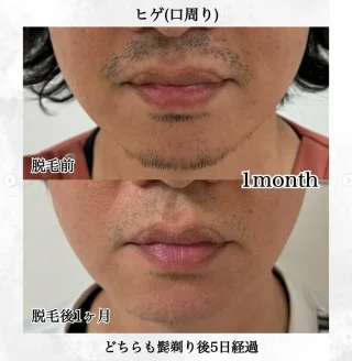 男性 ヒゲ脱毛