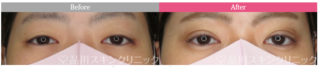 二重術1dayナチュラルプレミアム法