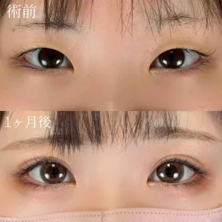 二重埋没法(自然癒着法)