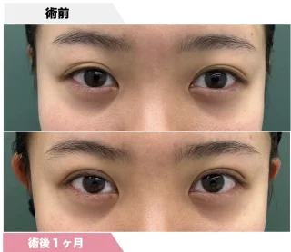 全切開式重瞼術