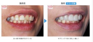 セラミック