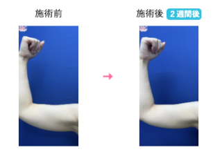 二の腕の脂肪吸引