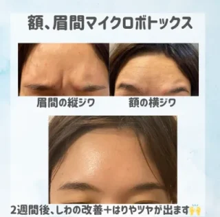 しわ・たるみ治療