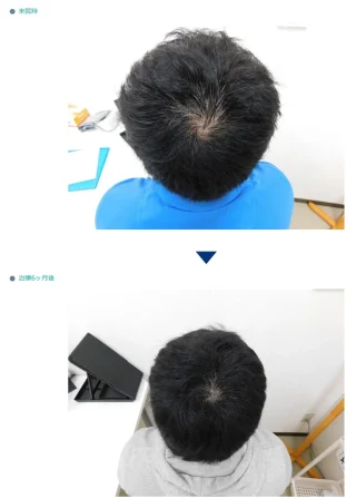 内服薬・外用薬による薄毛の改善事例（30代男性・6ヶ月後）