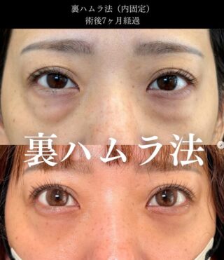 裏ハムラ法