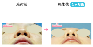 鼻尖形成術（だんご鼻解消術） 他
