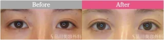 二重術1dayナチュラルプレミアム法