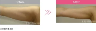 クールスカルプティング