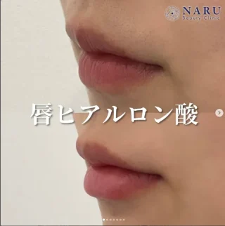 唇ヒアルロン酸