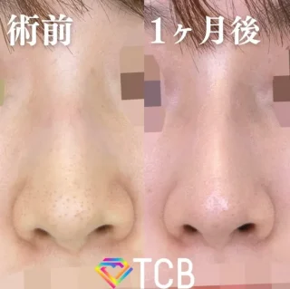 TCBメッシュ