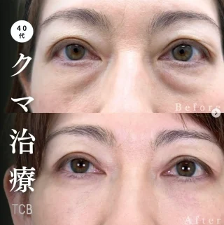 目の下のクマ取り