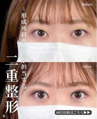 TCB式 1dayクイックアイ(二重埋没法)