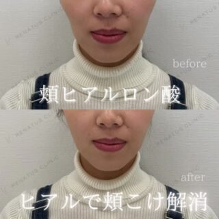 頬コケヒアルロン酸ボリフト