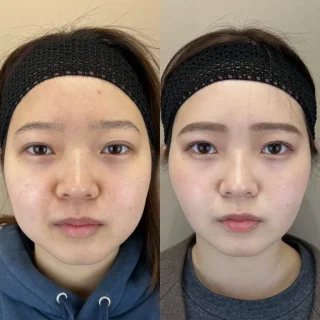 小顔美肌再生（リフトアップ）