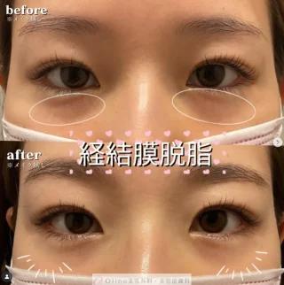 経結膜脱脂