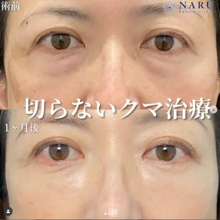 切らないクマ治療