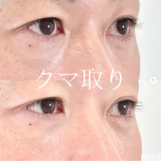 切らない⽬の下のクマ取り・たるみ取り
