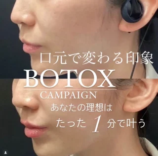 くちびるボトックス