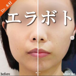 エラボトックス