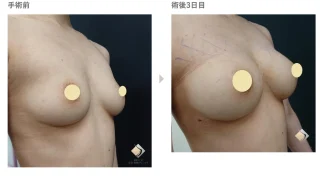アキーセル併用コンデンスリッチ豊胸