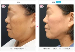 根こそぎVASER脂肪吸引