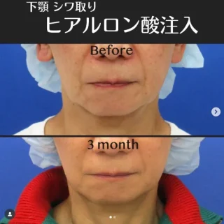 ヒアルロン酸注入