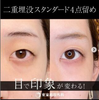二重埋没スタンダード4点留め