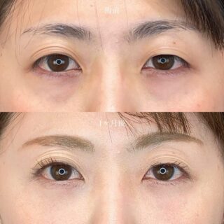 切らない目の下のクマ取り・目の下のたるみ（ふくらみ）取り