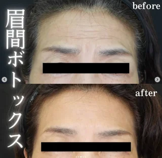 眉間ボトックス
