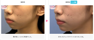 ヒアルロン酸