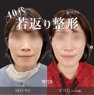TCB式小顔美肌再生