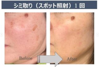しみ取り