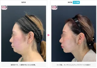 小顔用脂肪吸引注射