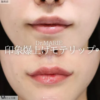 口角挙上(口角リフト)