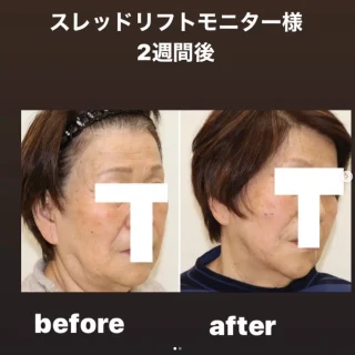 スレッドリフトアップ