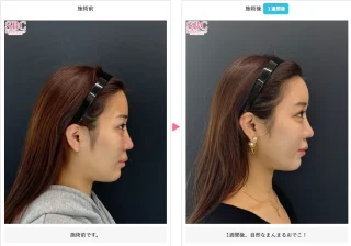 ナチュラル脂肪注射