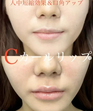 Cカールリップ