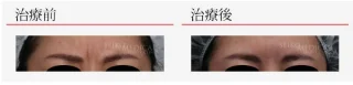 ボツリヌストキシン注入(眉間)