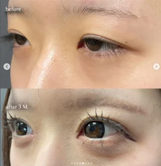 埋没二重＋目頭切開
