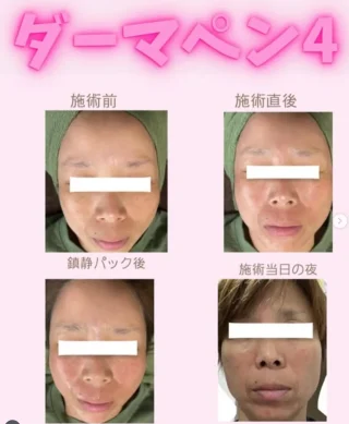 ダーマペン