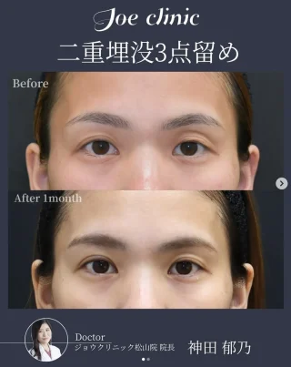 二重埋没法【3点留め】