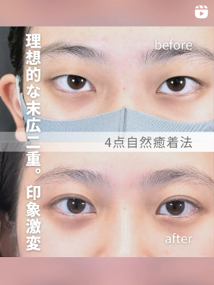二重埋没法