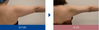 上腕、肩脂肪吸引