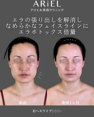 エラボトックス倍量
