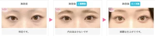 裏ハムラ法