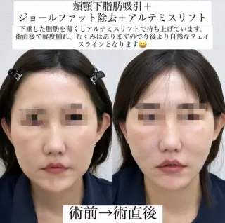小顔脂肪吸引と糸リフト