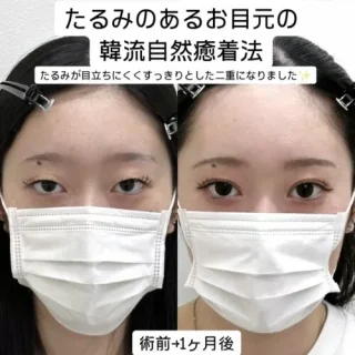 二重埋没法