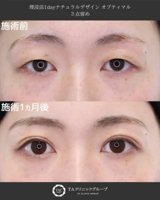 埋没法1dayナチュラルデザイン オプティマル3点留め